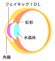tFCLbNIOL