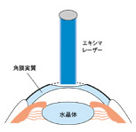 PRK(レーザー屈折角膜切術)